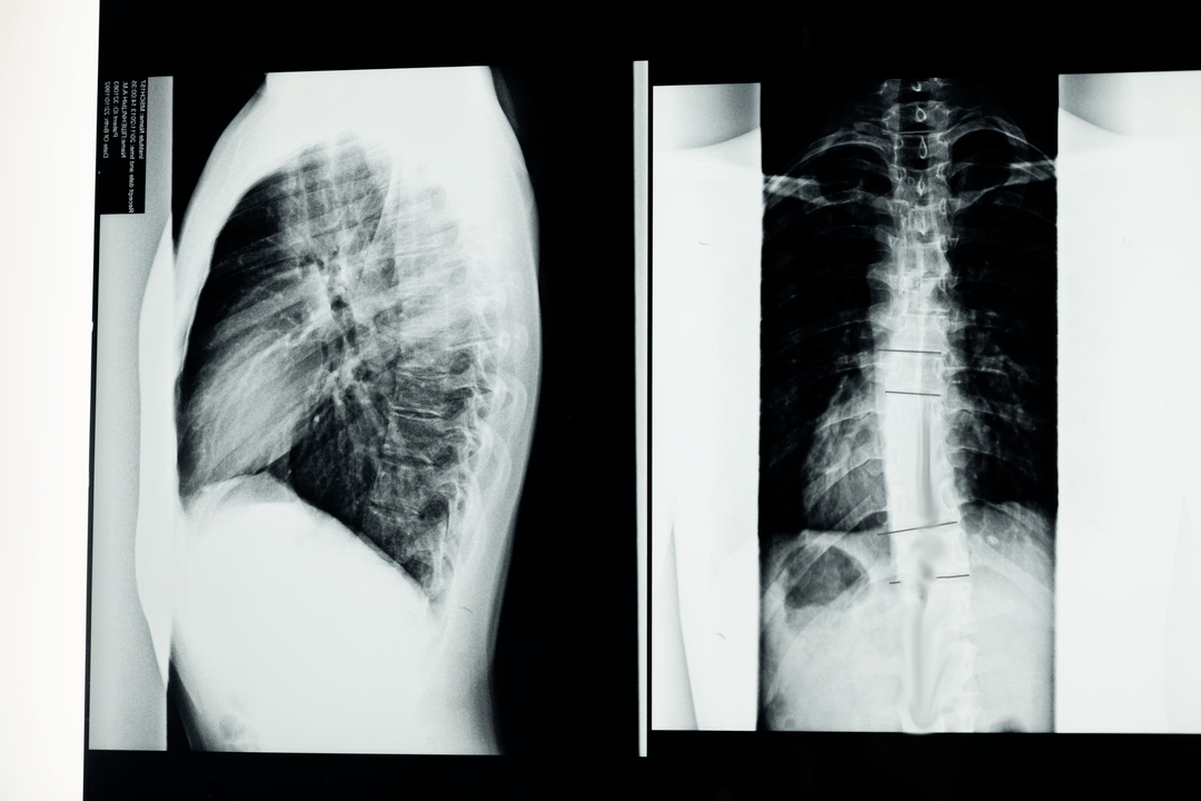 Kaklo stuburo osteochondrozė paveikslėlyje
