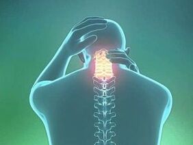 Gimdos kaklelio osteochondrozės simptomas yra galvos skausmas