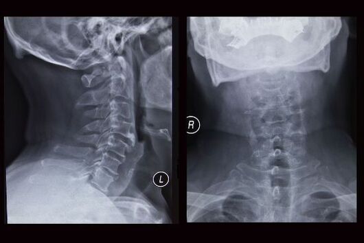 Gimdos kaklelio stuburo rentgeno vaizdas (pacientė serga osteochondroze)
