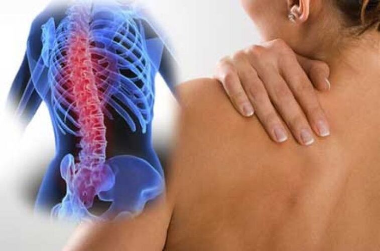Sergant osteochondroze, skausmas gali plisti į tolimas kūno dalis