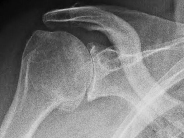 Artrozės pažeisto peties sąnario rentgenas
