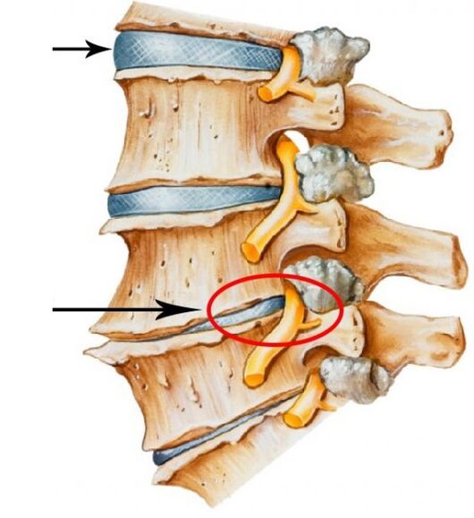 gimdos kaklelio osteochondrozė