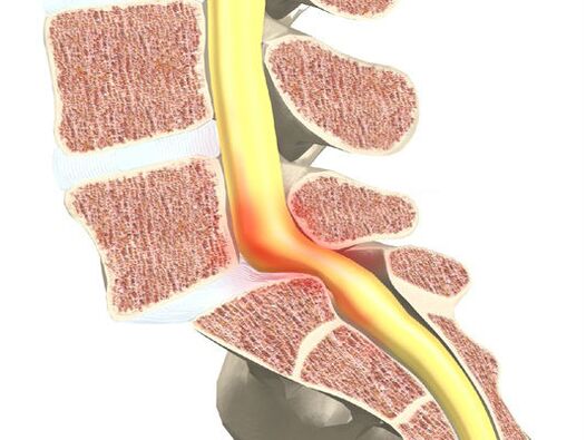 Kraujo-motorinis segmentas osteochondrozei