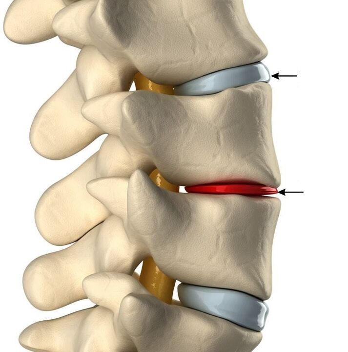 Skirtumas tarp sveiko disko ir disko su osteochondroze