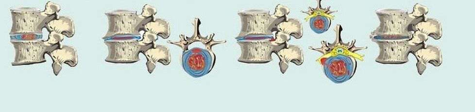 Įvairūs krūtinės ląstos osteochondrozės etapai