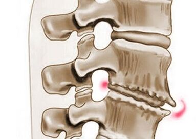 slankstelių pažeidimas sergant krūtinės ląstos osteochondroze