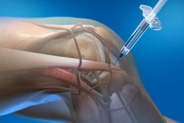 intraartikulinės injekcijos kelio sąnario artrozei